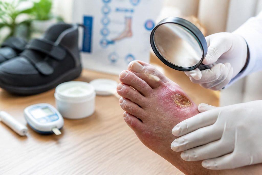 découvrez comment reconnaître, traiter et prévenir les complications du pied diabétique pour préserver votre santé et améliorer votre qualité de vie.